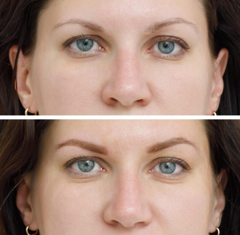 before and after eyebrow grooming venice