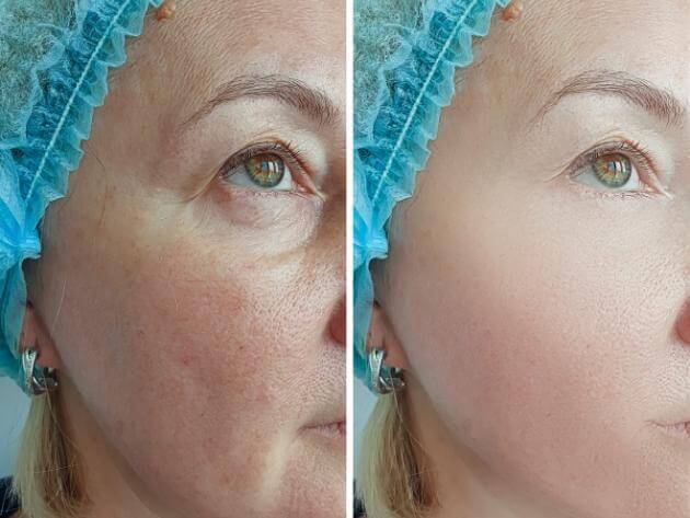 before and after juvederm treatment venice