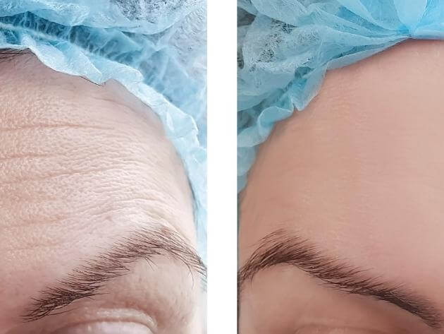 before and after prp treatment venice 1