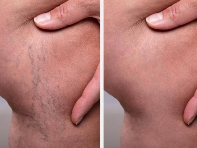 before and after prp treatment venice