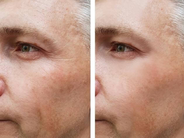 before and after restylane treatment venice