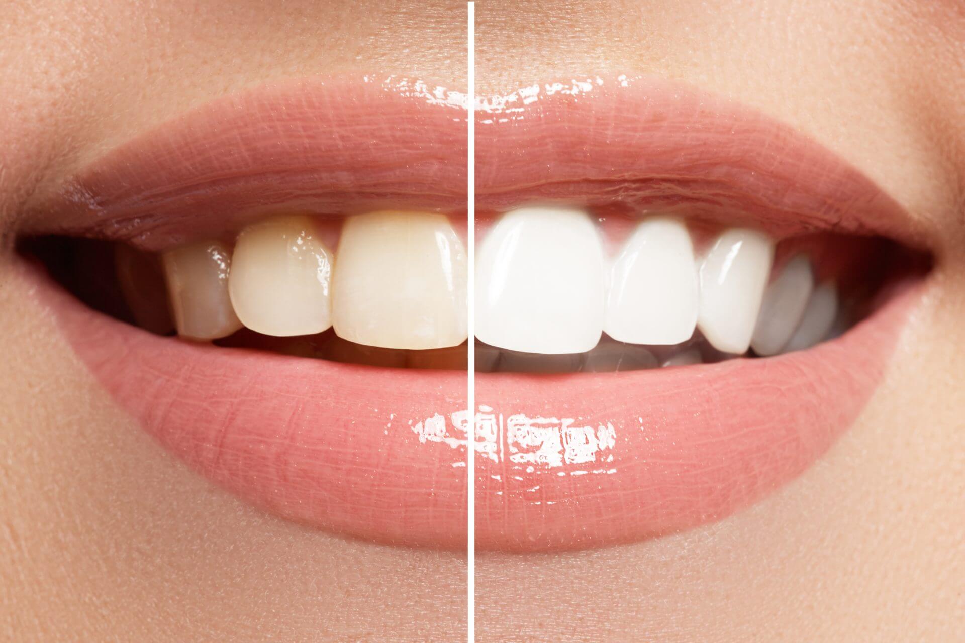 before and after teeth whitening venice