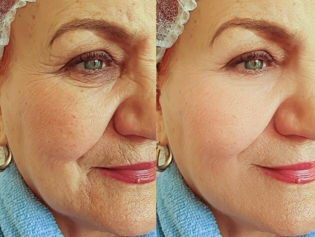 old lady with wrinkles undergoes dysport treatment venice