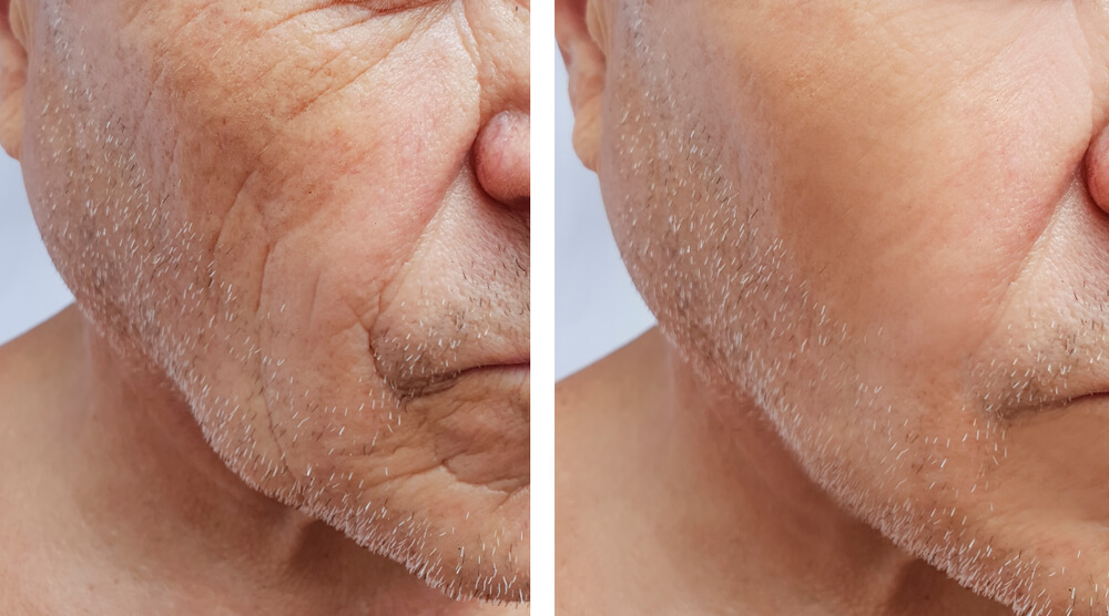 old man before and after botox treatment venice