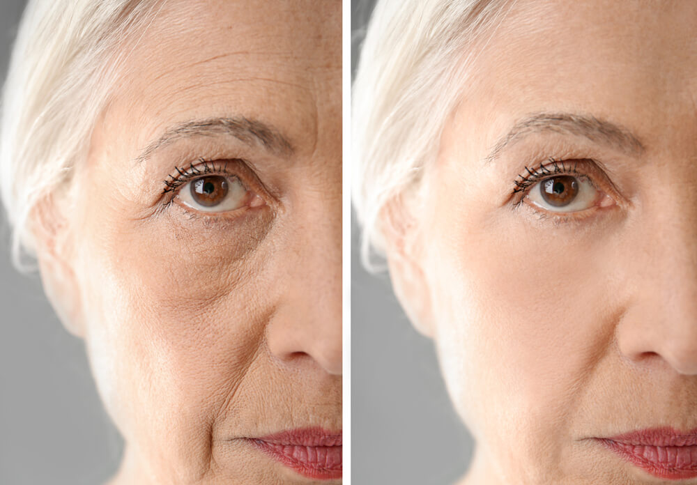 old woman before and after botox treatment venice